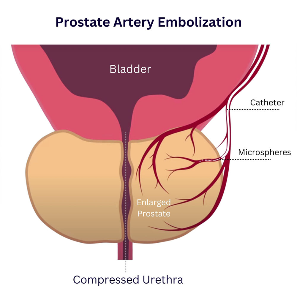 Prostate Artery Embolization