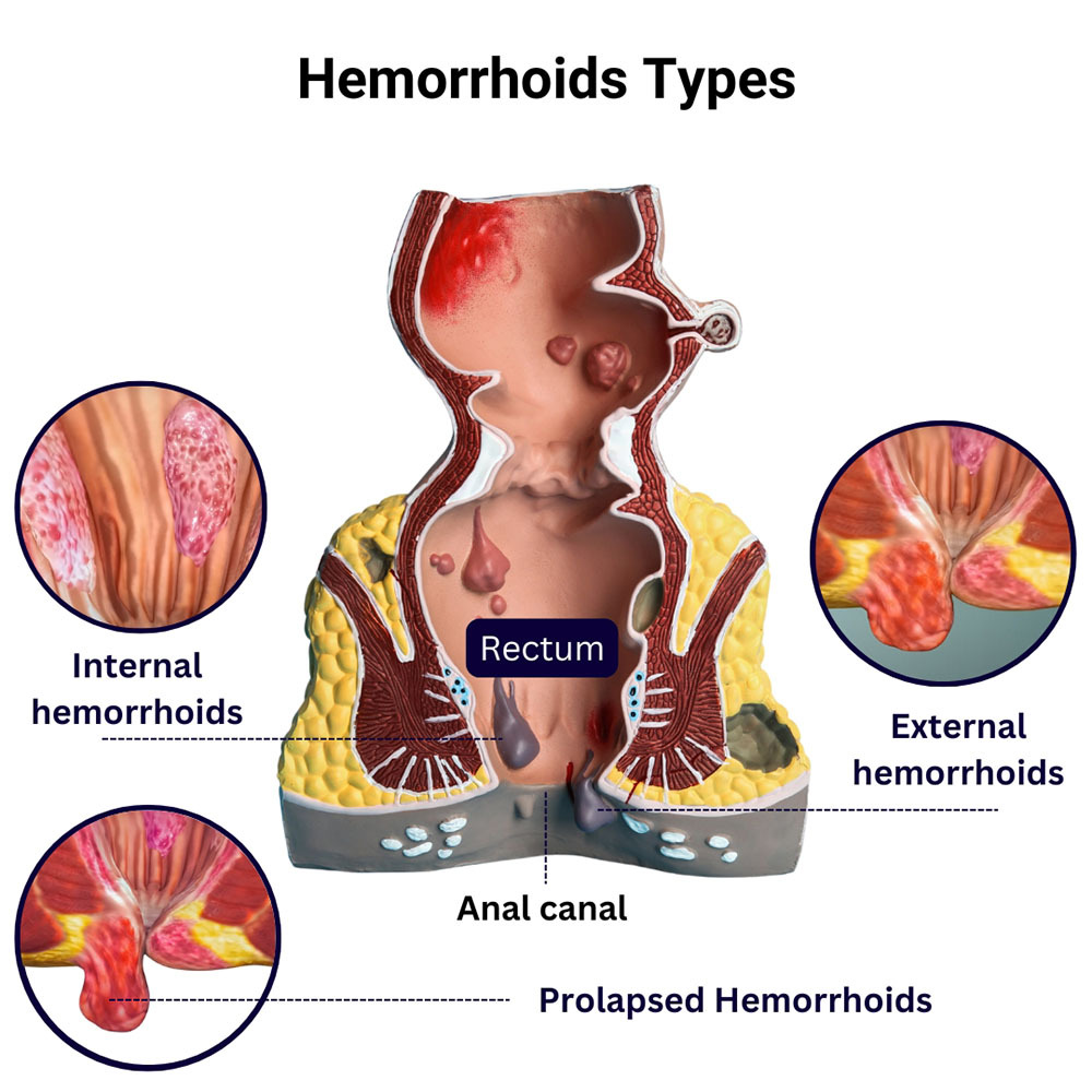 Types of Hemorrhoids