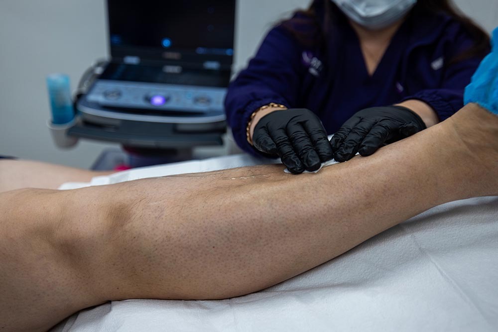 Vein Treatment Preparation Bronx, NY